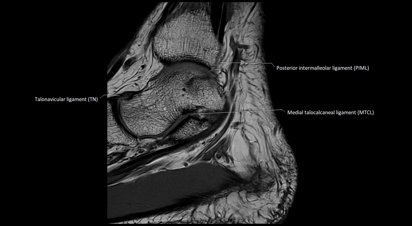 MRI ankle ligaments anatomy sagittal 3T image 8.webp